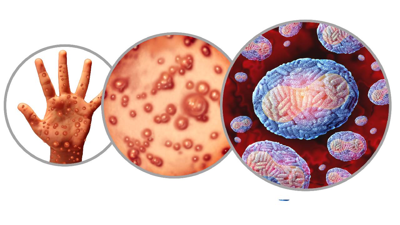 monkeypox-summary