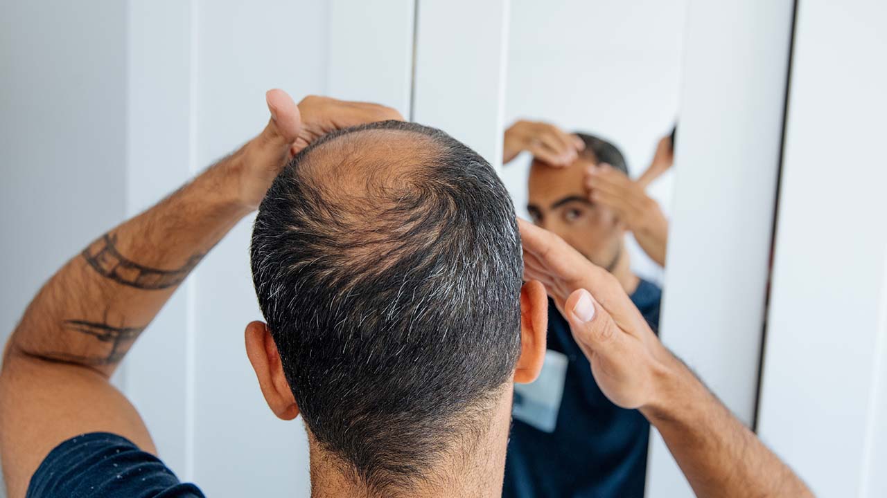 hair-loss-summary