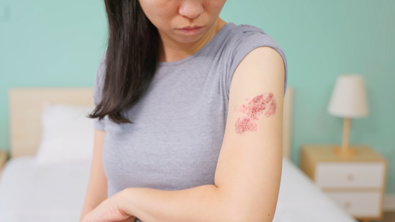 shingles-rash-on-female-summary