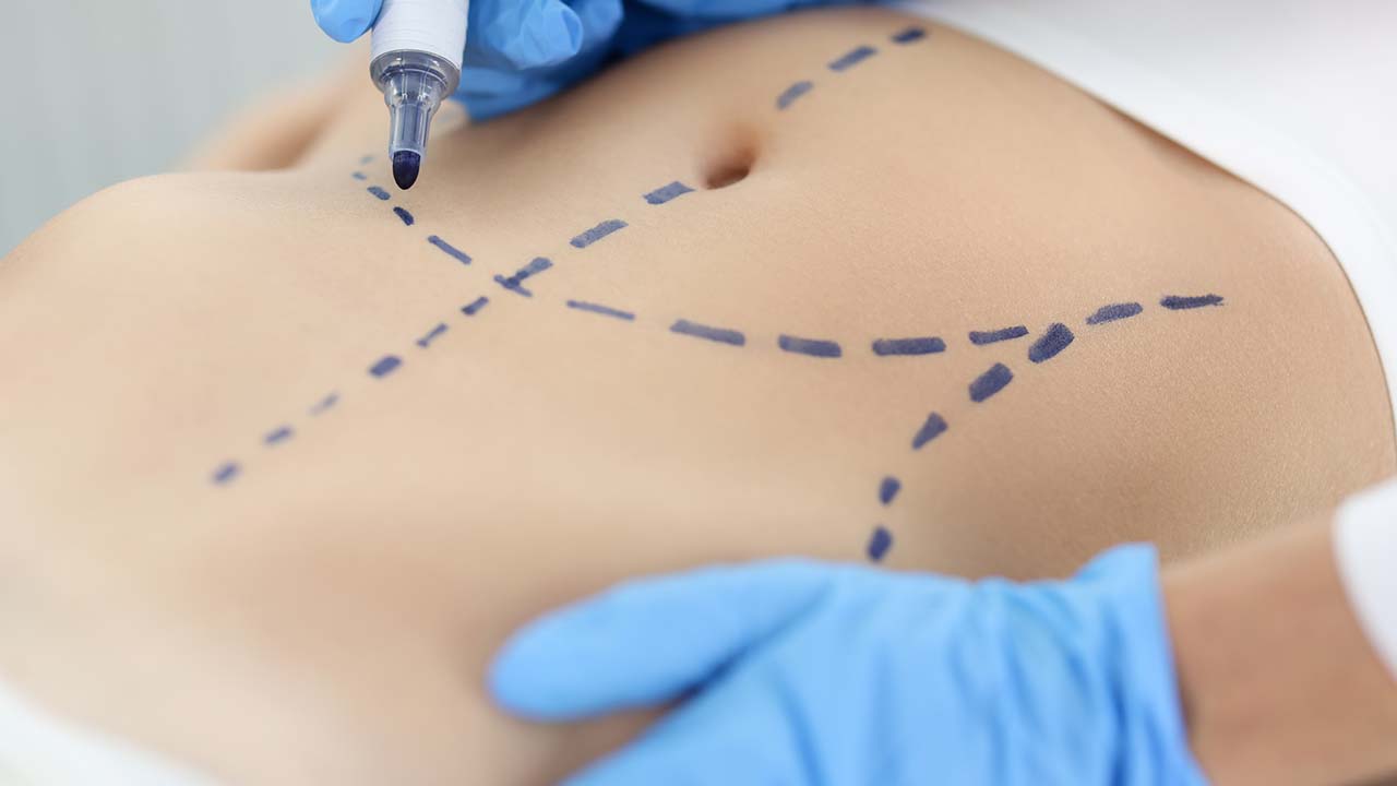 liposuction-summary